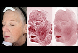 VISIA: ���������� ���������� RBX