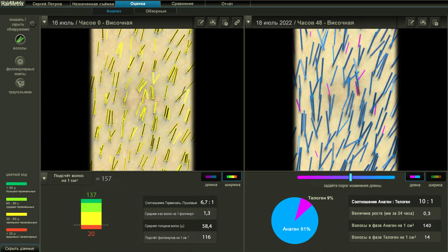 ��������� HairMetrix: ������ ������� ����� �����