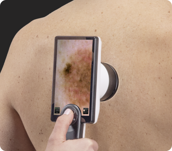 Дерматоскопическая фотосъёмка с помощью Цифрового дерматоскопа Визиомед Д2