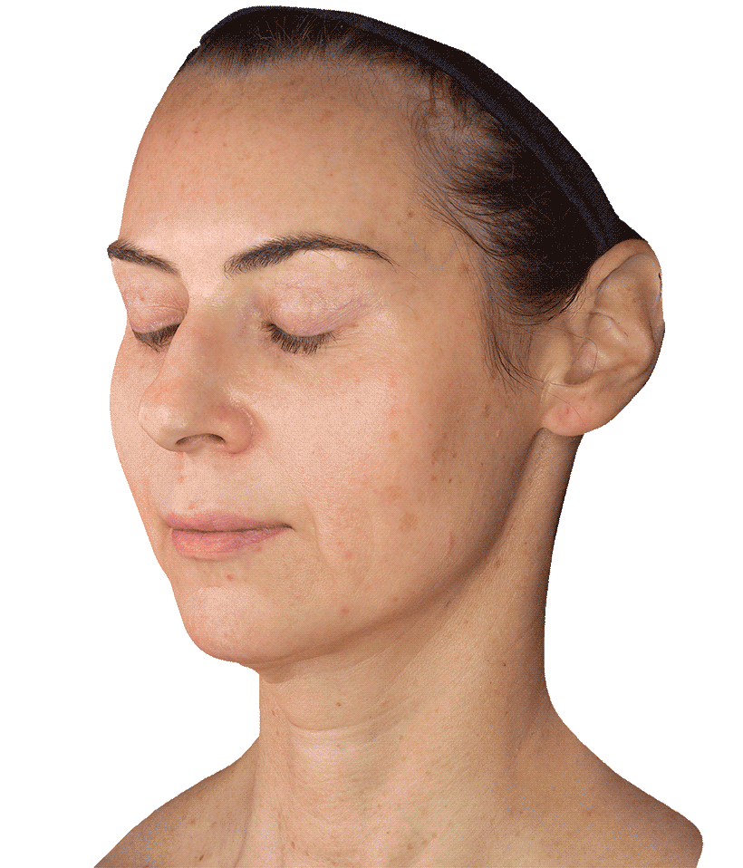 ������ ��������� VISIA 3D