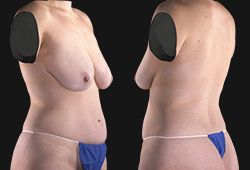 VECTRA XT: �������������� �������� �����������