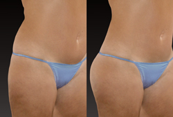 VECTRA H2: �������������� ����