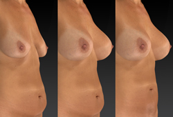 VECTRA H2: ����������� �������������� ��������