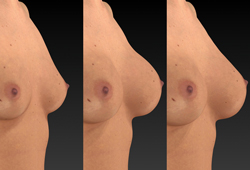 VECTRA H2: ������������ �������� ��������