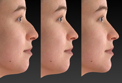 VECTRA H2: �������������� ����