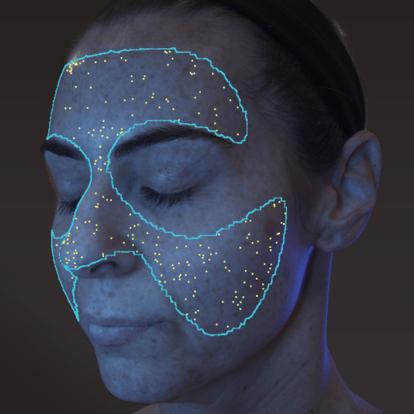 VISIA 3D: ������������� ����������� ���� - ���������