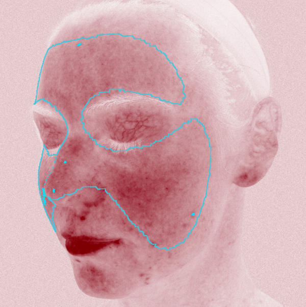 VISIA 3D: ������������� ����������� ���� - ������� �������