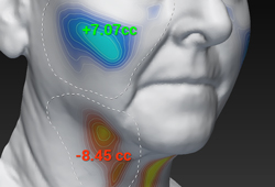 VISIA 3D: ��������� �������